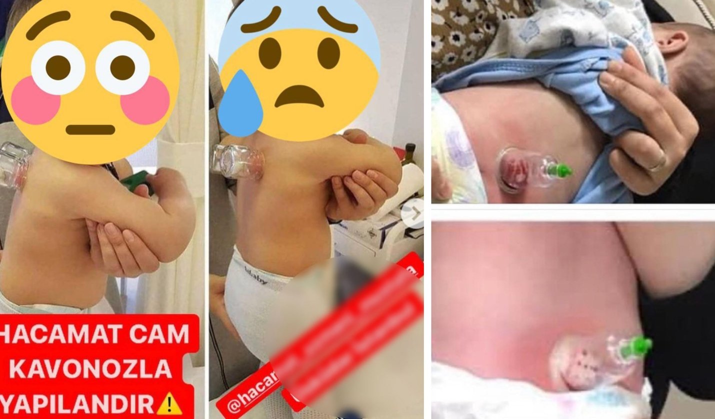 Hacamat Yapılan Bebek Görüntülerine Uzmanlardan Sert Uyarı: “Kesinlikle Yapılmamalı!”