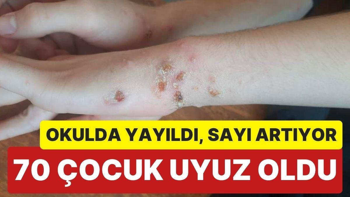 Hatay’da Su Problemi Devam Ediyor: Bir Okulda 70’ten Fazla Çocukta Uyuz Tespit Edildi