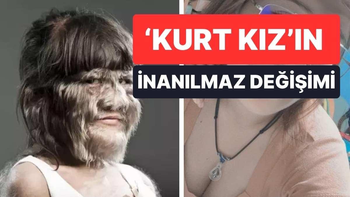 ‘Kurt Kız’ Büyüdü! ‘Dünyanın En Tüylü Kızı’nın Son Hali Görenleri Şaşkına Çevirdi!