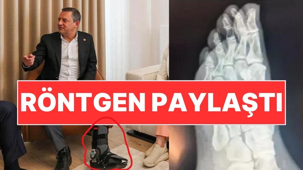 ‘Ayağından Vuruldu’ İddiaları Sonrası Özgür Özel’den Röntgen Filmi Paylaşımı!