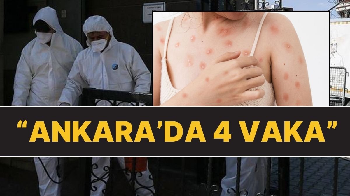 ‘Maymun Çiçeği Türkiye’ye Girdi’ İddiası: Ankara’da 4 Kişi Karantinaya Alındı!
