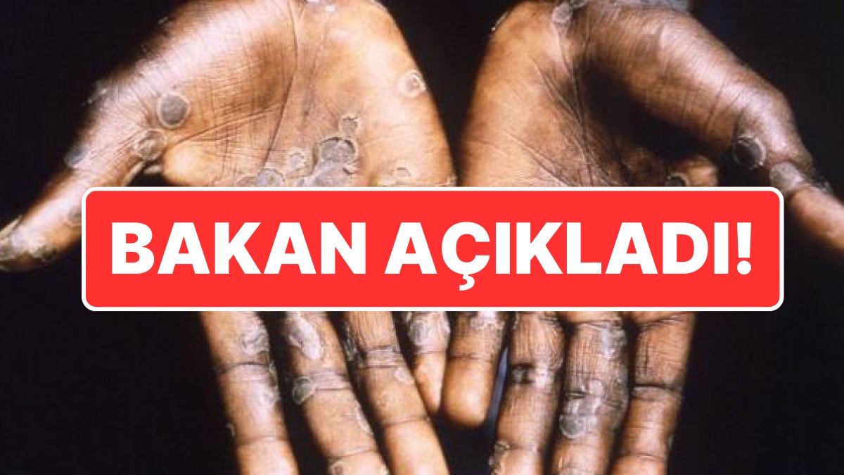 Sağlık Bakanı Kemal Memişoğlu’ndan Maymun Çiçeği Açıklaması: “Panik Yapmaya Gerek Yok”