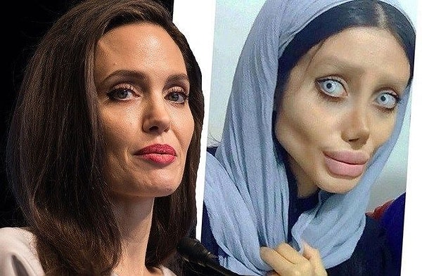 Estetik Ameliyat Memnuniyetsizine Ücret İadesi Şoku: Yargıtay Kararı