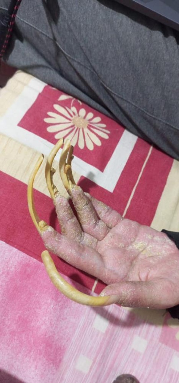 23 Yaşında Barış: Evden Çıkmayan, Banyosuz, Tırnaksız Oyun Bağımlılığı